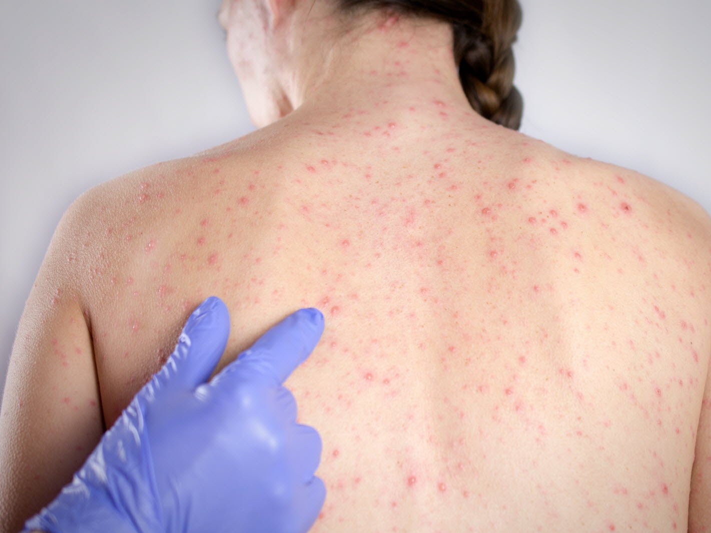 a-thorens-glieres-sur-les-quinze-cas-detectes-(dont-13-confirmes)-entre-le-11-avril-et-le-5-mai-14-n-etaient-pas-vaccines-photo-adobe-stock-1748027510